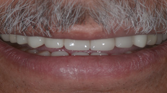 Porcelain Dental Veneers Increasing Teeth Visibility